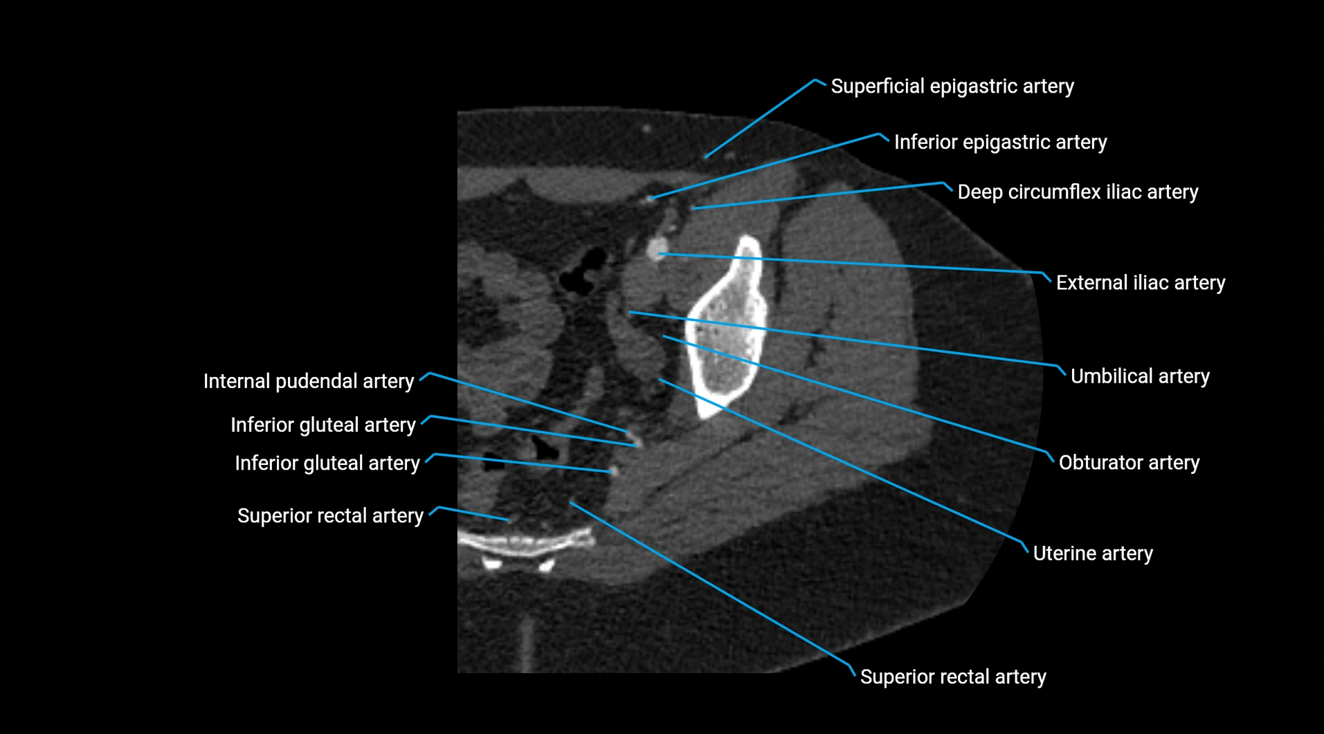 CTA lower limb cross sectional anatomy labelled image _44.webp